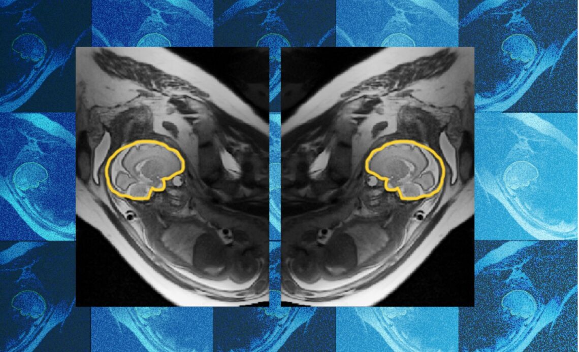 Why teaching AI about symmetry could make prenatal diagnosis more reliable | MIT News